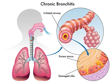 chronic bronchitis 뜻